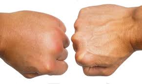 Swelling