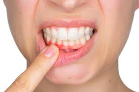 Tooth Gum