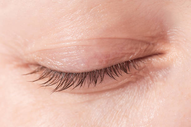 Eyelid
