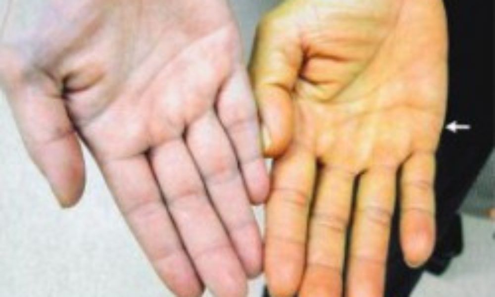 Jaundice, yellowing of the skin and white part of eyes due to excess of bilirubin
