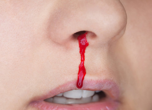 Spontaneous Hemorrhage normally from mouth or nose