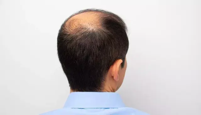 Head (Bald)